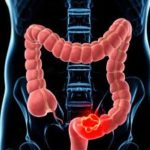 10 Cara Mengatasi Sindrom Usus Iritabel