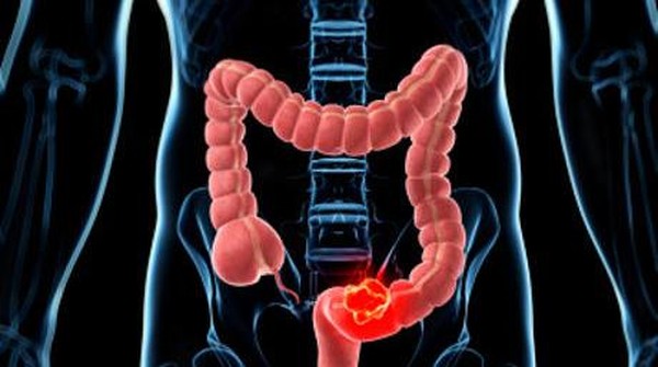 10 Cara Mengatasi Sindrom Usus Iritabel