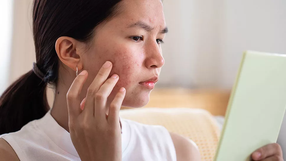 5 Cara Mencegah dan Mengobati Acne di Usia Dewasa