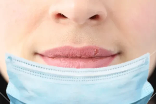 10 Cara Mengatasi Bibir Kering Akibat Masker Medis
