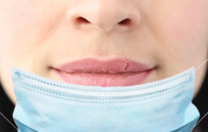10 Cara Mengatasi Bibir Kering Akibat Masker Medis
