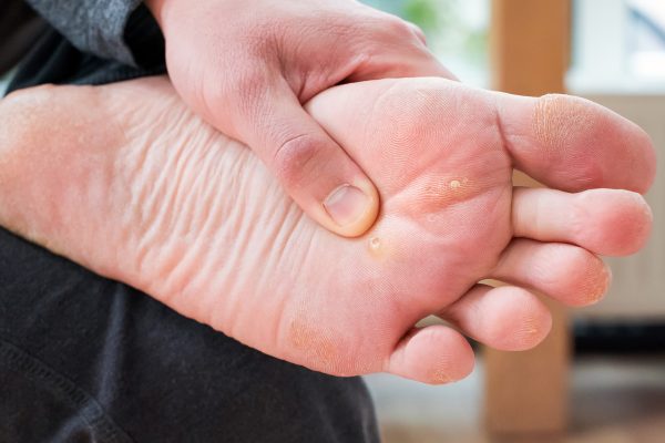 7 Cara Merawat Kaki Agar Terhindar dari Kapalan
