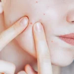 10 Bahan Alami yang Ampuh Mengatasi Jerawat Kecil