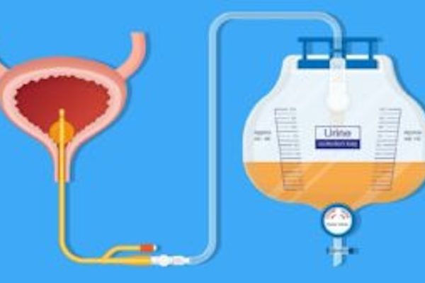 5 Langkah Cegah Infeksi Saluran Kemih pada Pasien Lumpuh